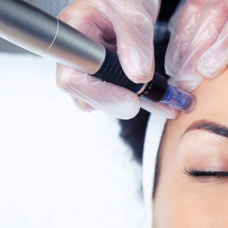 Morpheus8 treatment East Grinstead from Lipo Sculpt - Book in today!