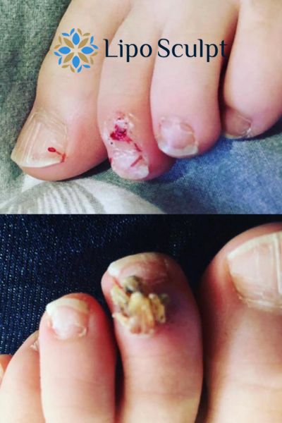 Wart removal customer results from Lipo Sculpt East Grinstead